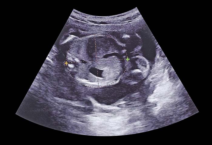 سونوگرافی در هفته ۱۹ بارداری