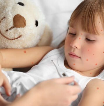 آبله مرغان کودکان