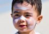 آفتاب سوختگی در نوزادان و کودکان