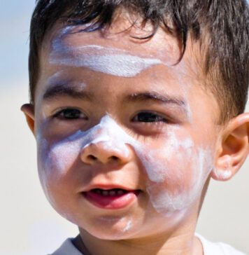 آفتاب سوختگی در نوزادان و کودکان