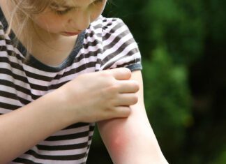 زرد زخم در کودکان ؛ علت ها و راه های درمان زرد زخم در کودکان