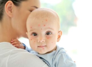 آبله مرغان در کودکان