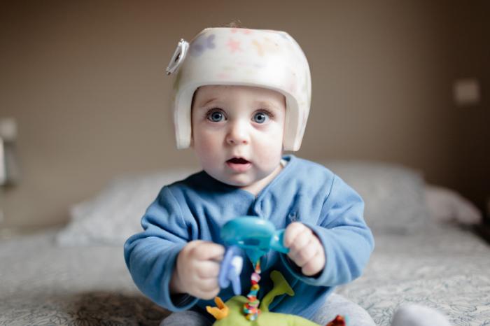 کلاه درمانی برای نوزادان