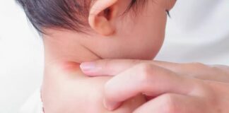 جوش گردن در نوزادان