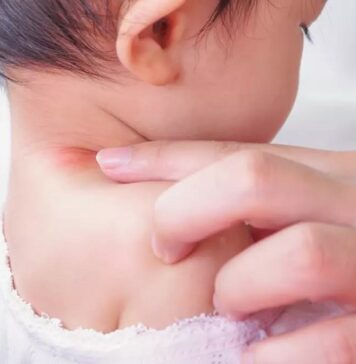 جوش گردن در نوزادان